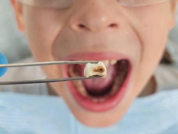 Best Emergency Treatment for Oral Infections in Kilauea, HI